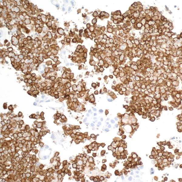 Detection of human CD163 in FFPE lung carcinoma pleural fluid by IHC.