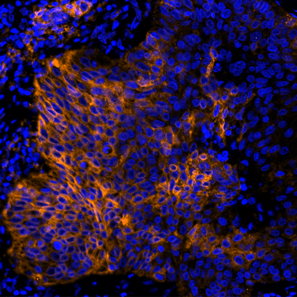 Detection of human PD-L1 (orange) in FFPE lung carcinoma by IHC-IF (pseudo color).