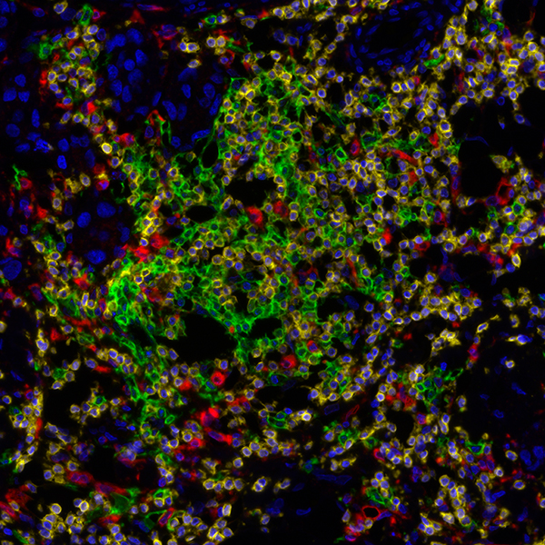 Detection of human CD3 (yellow), CD20 (green), and CD68 (red) in FFPE lung carcinoma by IHC-IF.
