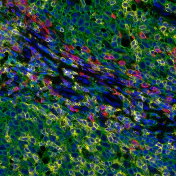 Detection of human CD3E (yellow), CD8 alpha (red), and CD20 (green) in FFPE tonsil by IHC-IF.