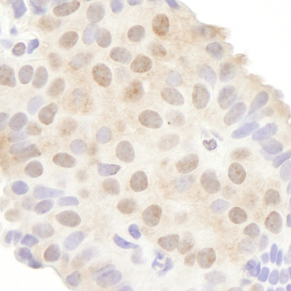 Detection of human DDX20 in FFPE breast carcinoma by IHC.