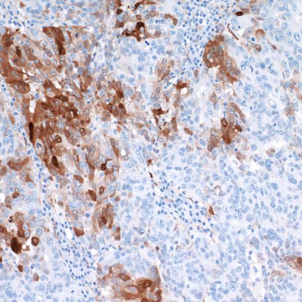 Detection of human IDO1 in FFPE ovarian carcinoma by IHC.