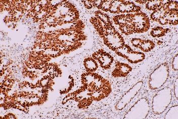 Microscopic image colon cancer with positive PMS2 immuno stain (no loss of expression)