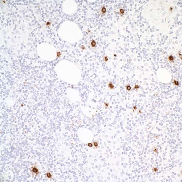Detection of human Granzyme B in FFPE metastatic lymph node by IHC.