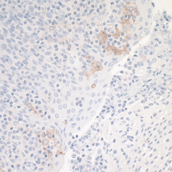 Detection of human RanBP1 in FFPE colon carcinoma.
