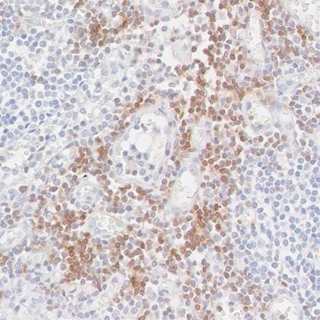 Detection of CD247/CD3Z in a FFPE section of metastatic lymph node from lung cancer origin by IHC.