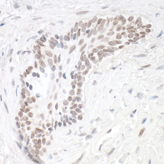 Detection of human HIF1-alpha in FFPE renal cell carcinoma by IHC.