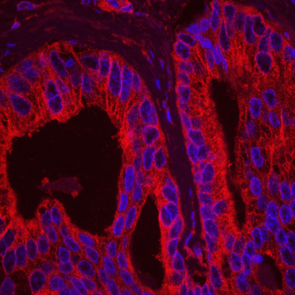 Detection of human EB1 (red) in FPPE prostate carcinoma.