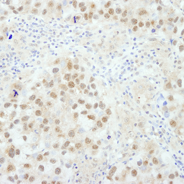 Detection of human BRC1 in FFPE breast carcinoma by IHC.