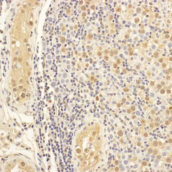 Detection of human MAP1S in FFPE testicular seminoma by IHC.