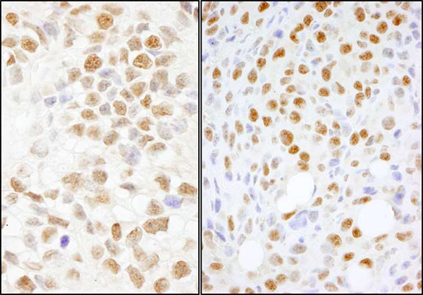 Detection of human and mouse NONO in FFPE breast carcinoma (left) and mouse squamous cell carcinoma (right) by IHC.