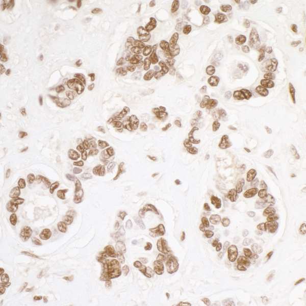 Detection of human KAP-1 in FFPE ovarian carcinoma by IHC.